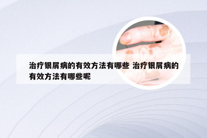 治疗银屑病的有效方法有哪些 治疗银屑病的有效方法有哪些呢