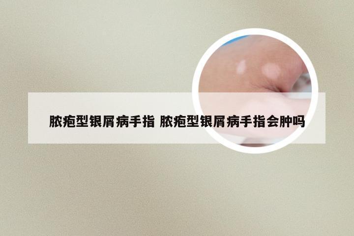 脓疱型银屑病手指 脓疱型银屑病手指会肿吗