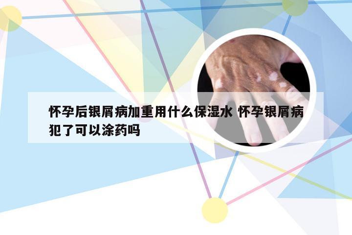 怀孕后银屑病加重用什么保湿水 怀孕银屑病犯了可以涂药吗