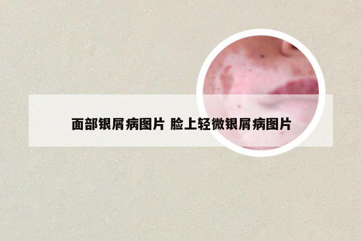 面部银屑病图片 脸上轻微银屑病图片