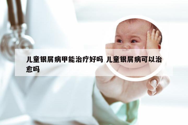儿童银屑病甲能治疗好吗 儿童银屑病可以治愈吗
