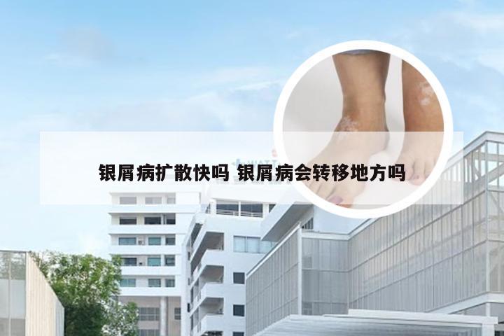 银屑病扩散快吗 银屑病会转移地方吗