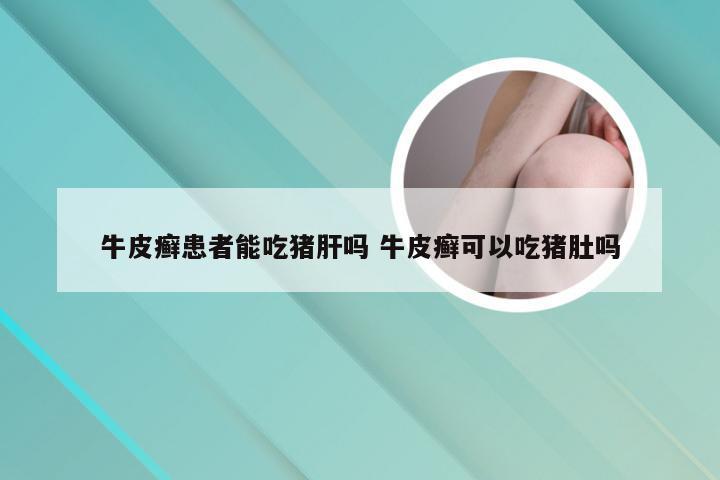 牛皮癣患者能吃猪肝吗 牛皮癣可以吃猪肚吗