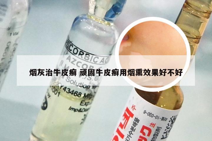 烟灰治牛皮癣 顽固牛皮癣用烟熏效果好不好
