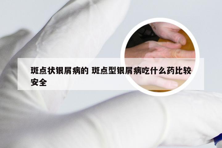 斑点状银屑病的 斑点型银屑病吃什么药比较安全