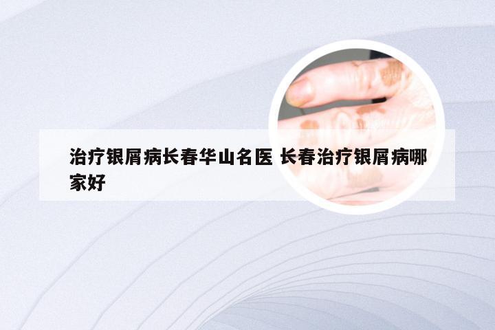 治疗银屑病长春华山名医 长春治疗银屑病哪家好