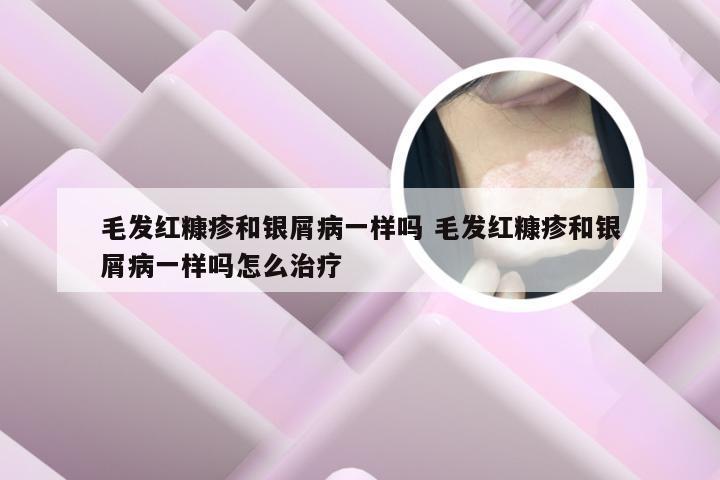 毛发红糠疹和银屑病一样吗 毛发红糠疹和银屑病一样吗怎么治疗