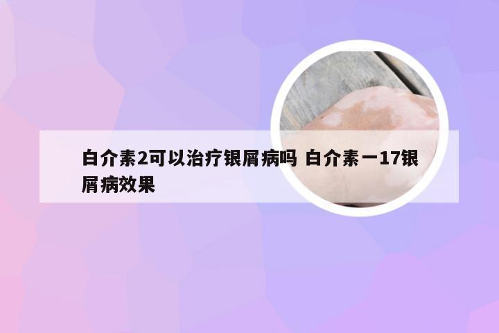 白介素2可以治疗银屑病吗 白介素一17银屑病效果