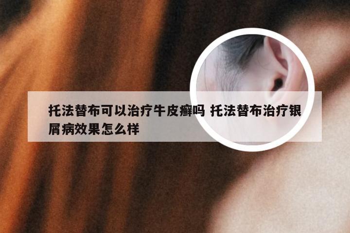 托法替布可以治疗牛皮癣吗 托法替布治疗银屑病效果怎么样