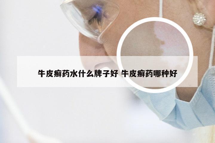 牛皮癣药水什么牌子好 牛皮癣药哪种好