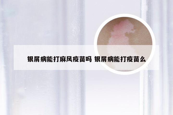 银屑病能打麻风疫苗吗 银屑病能打疫苗么
