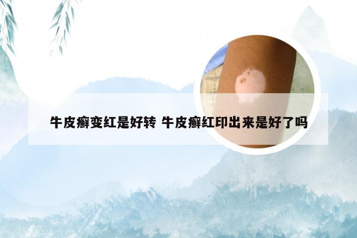 牛皮癣变红是好转 牛皮癣红印出来是好了吗