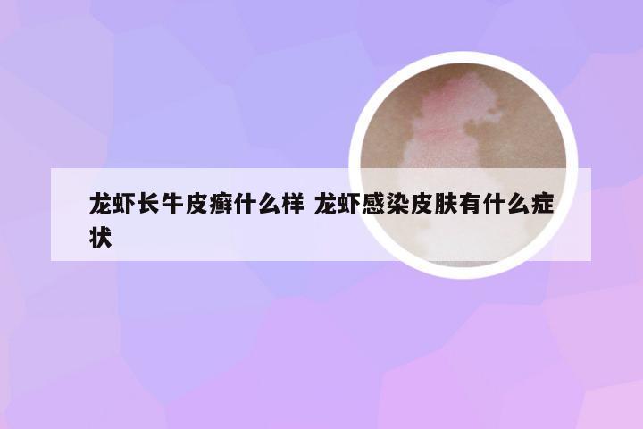 龙虾长牛皮癣什么样 龙虾感染皮肤有什么症状