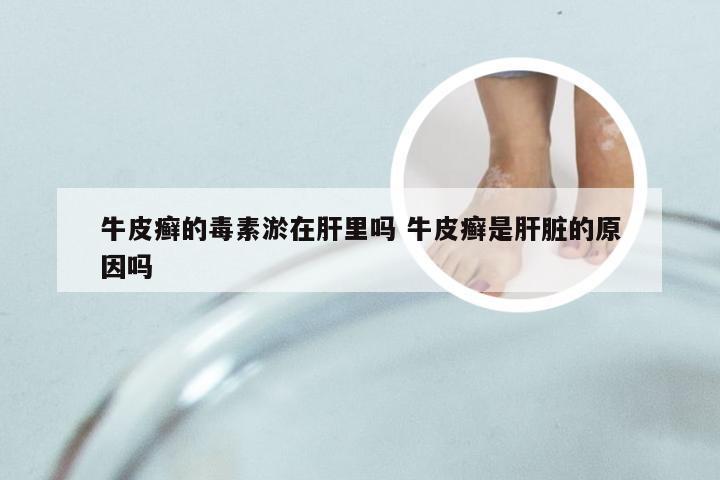 牛皮癣的毒素淤在肝里吗 牛皮癣是肝脏的原因吗