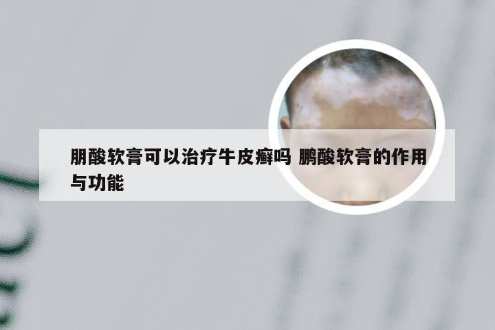 朋酸软膏可以治疗牛皮癣吗 鹏酸软膏的作用与功能