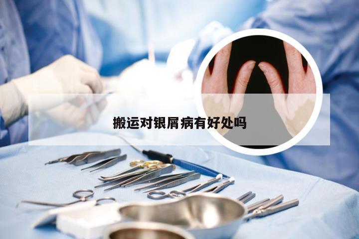 搬运对银屑病有好处吗