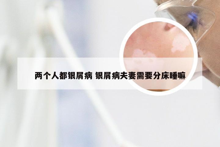 两个人都银屑病 银屑病夫妻需要分床睡嘛