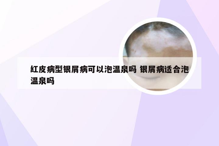 红皮病型银屑病可以泡温泉吗 银屑病适合泡温泉吗