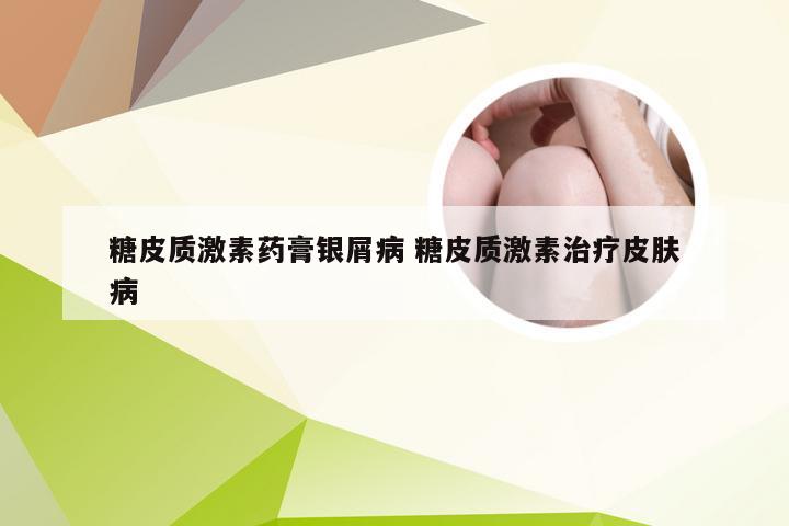 糖皮质激素药膏银屑病 糖皮质激素治疗皮肤病