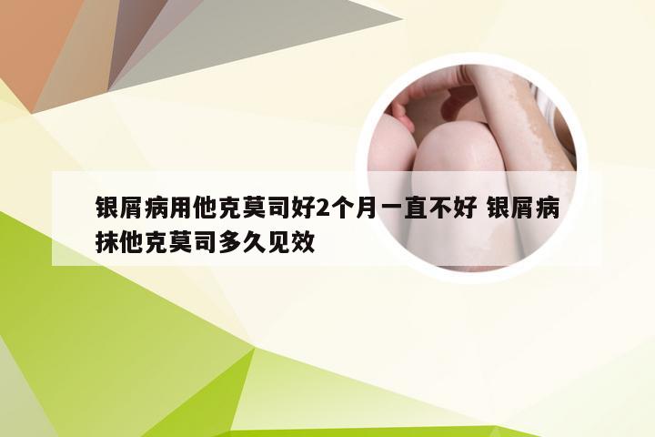 银屑病用他克莫司好2个月一直不好 银屑病抹他克莫司多久见效