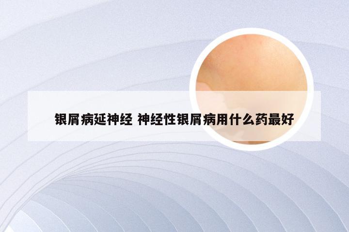 银屑病延神经 神经性银屑病用什么药最好