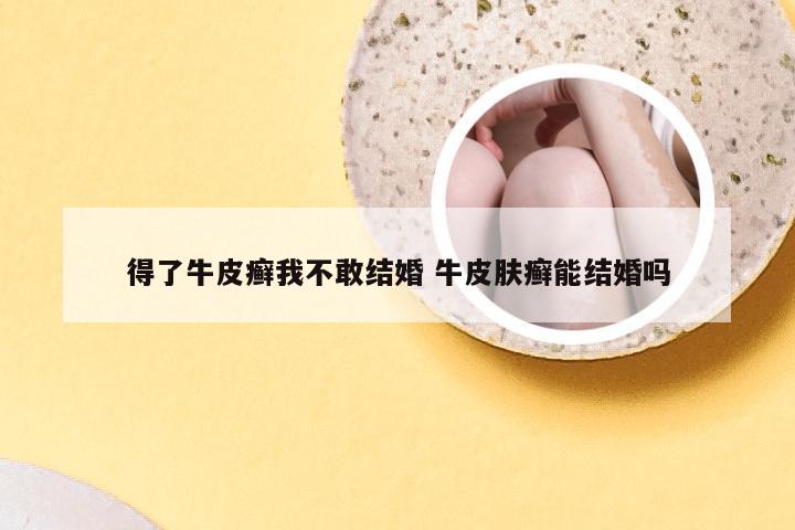 得了牛皮癣我不敢结婚 牛皮肤癣能结婚吗