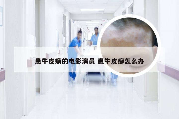 患牛皮癣的电影演员 患牛皮癣怎么办