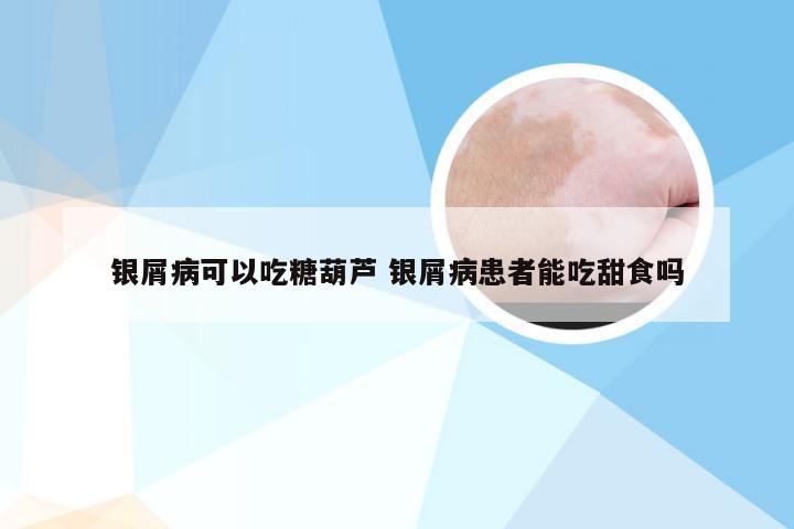银屑病可以吃糖葫芦 银屑病患者能吃甜食吗