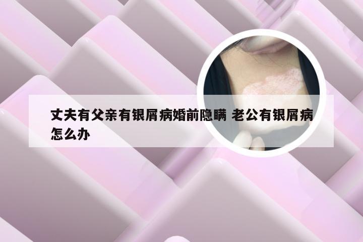 丈夫有父亲有银屑病婚前隐瞒 老公有银屑病怎么办