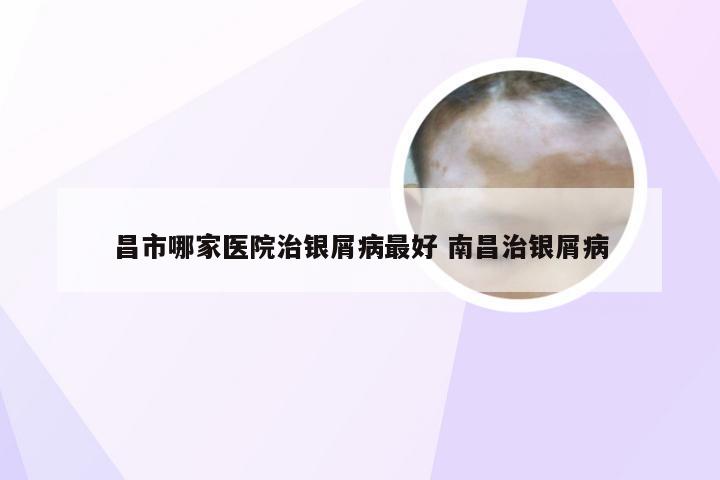 昌市哪家医院治银屑病最好 南昌治银屑病