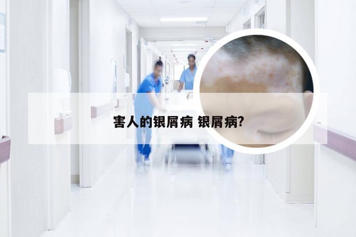 害人的银屑病 银屑病?