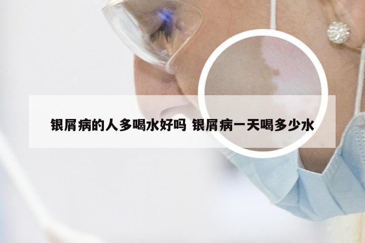 银屑病的人多喝水好吗 银屑病一天喝多少水