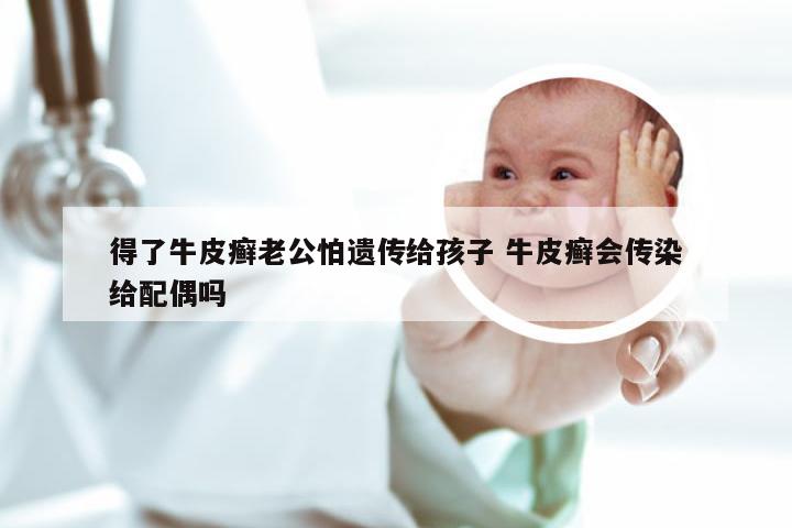 得了牛皮癣老公怕遗传给孩子 牛皮癣会传染给配偶吗