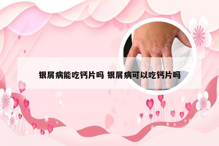银屑病能吃钙片吗 银屑病可以吃钙片吗