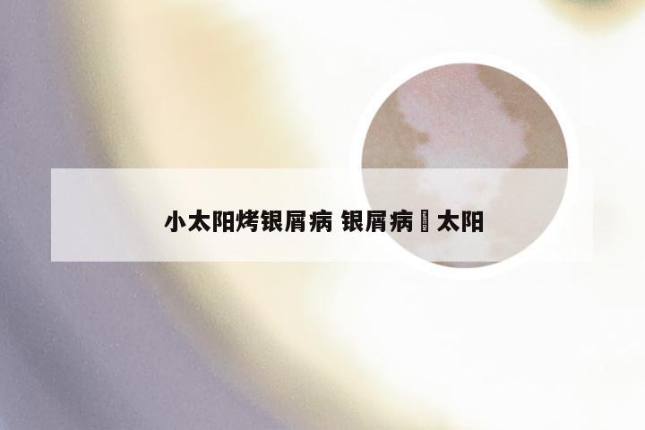 小太阳烤银屑病 银屑病嗮太阳