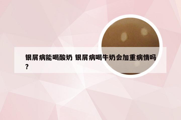 银屑病能喝酸奶 银屑病喝牛奶会加重病情吗?