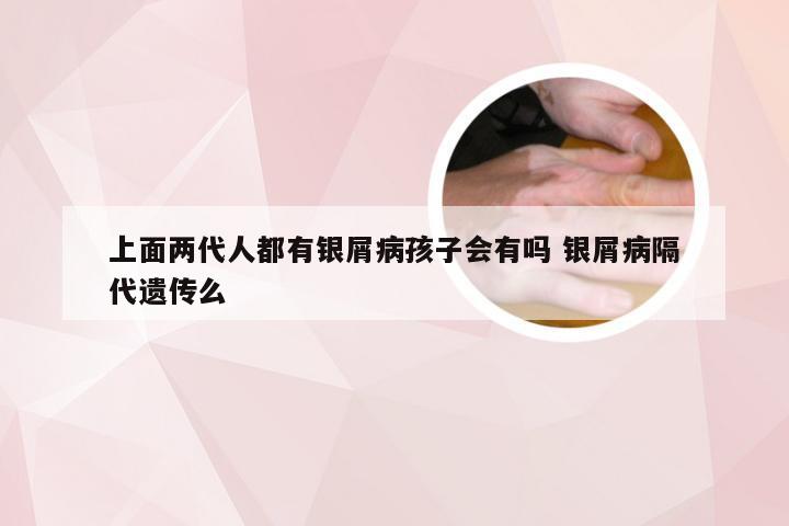 上面两代人都有银屑病孩子会有吗 银屑病隔代遗传么