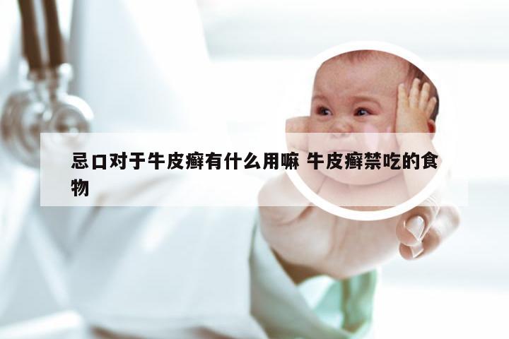 忌口对于牛皮癣有什么用嘛 牛皮癣禁吃的食物