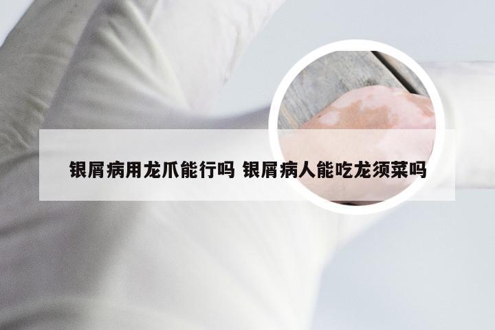 银屑病用龙爪能行吗 银屑病人能吃龙须菜吗