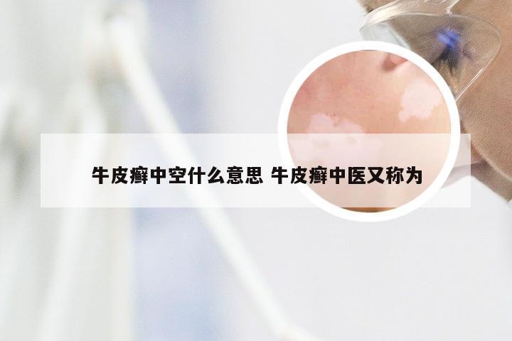 牛皮癣中空什么意思 牛皮癣中医又称为