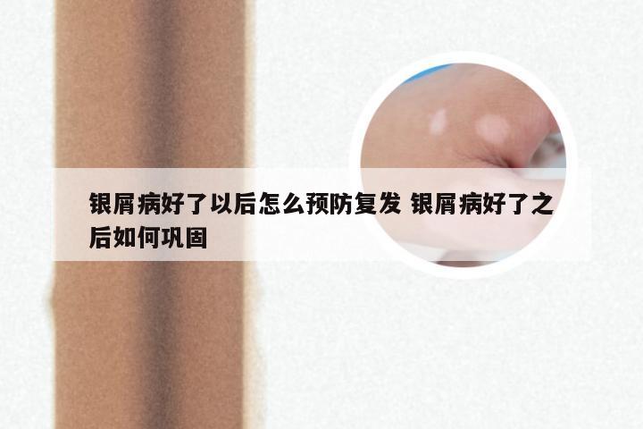 银屑病好了以后怎么预防复发 银屑病好了之后如何巩固