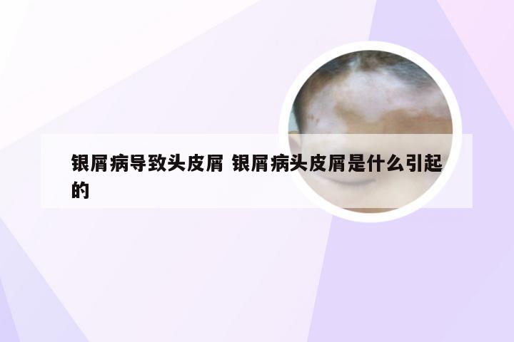 银屑病导致头皮屑 银屑病头皮屑是什么引起的