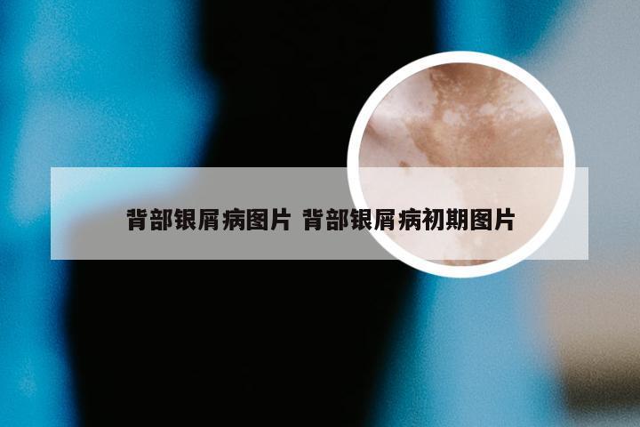 背部银屑病图片 背部银屑病初期图片