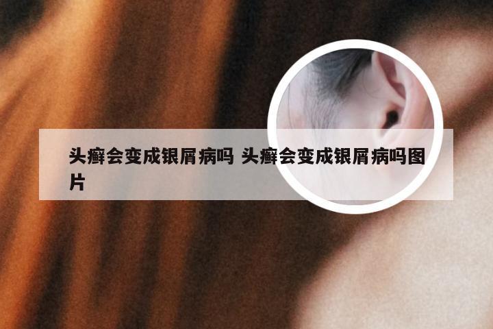 头癣会变成银屑病吗 头癣会变成银屑病吗图片