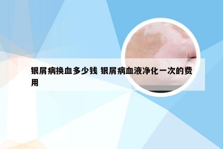 银屑病换血多少钱 银屑病血液净化一次的费用
