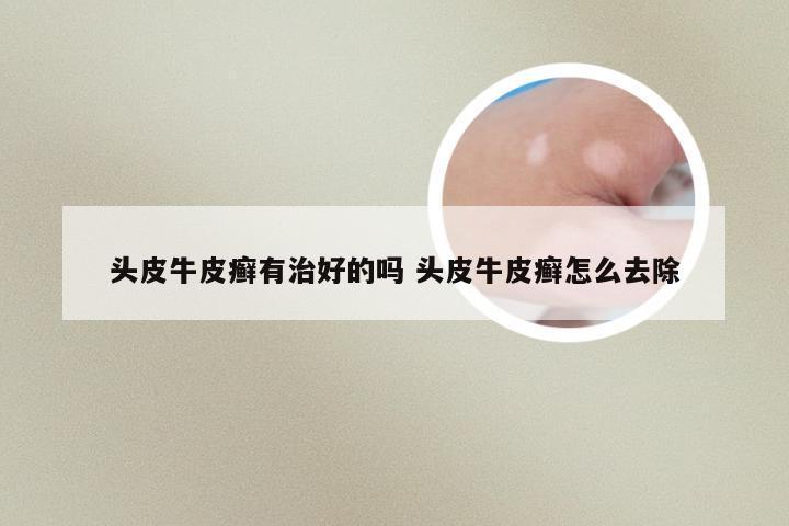头皮牛皮癣有治好的吗 头皮牛皮癣怎么去除