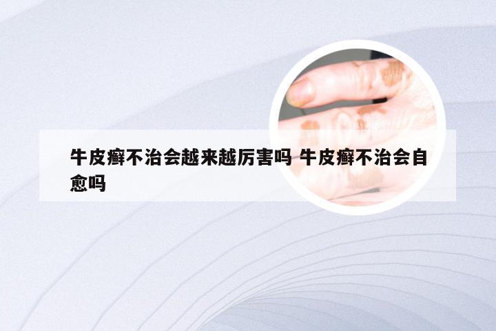 牛皮癣不治会越来越厉害吗 牛皮癣不治会自愈吗