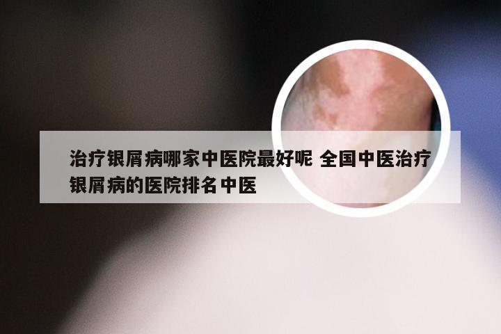 治疗银屑病哪家中医院最好呢 全国中医治疗银屑病的医院排名中医