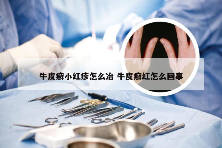 牛皮癣小红疹怎么冶 牛皮癣红怎么回事