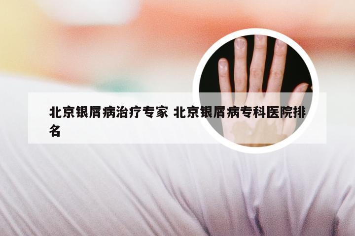 北京银屑病治疗专家 北京银屑病专科医院排名